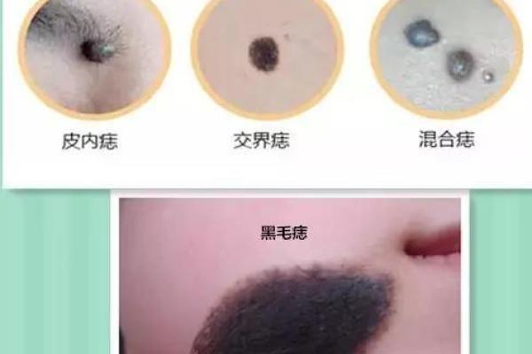 阴茎上长痣的原因与健康影响解析