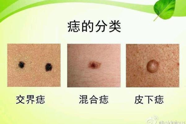 阴茎上长痣的原因与健康影响解析