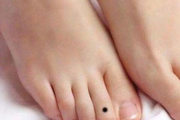 全面解析脚底痣的形态与运势