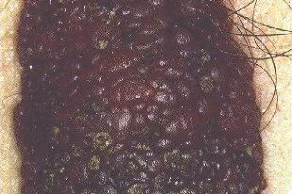 阴囊痣的变化及其可能的健康风险