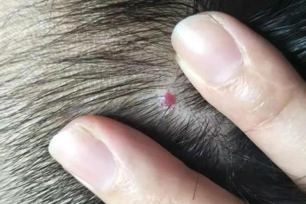 你身上的痣是否预示着未来的重大变化