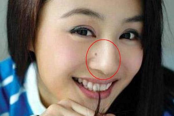 痣点掉落是否会影响命运与运势解析