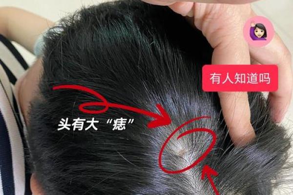 头顶相痣的吉凶与性格特征