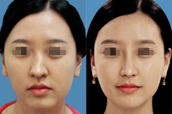 鼻子歪了能改善吗？面相中的鼻子歪代表什么