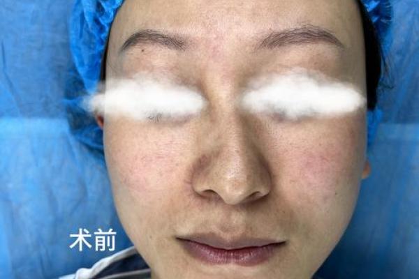 鼻子歪了能改善吗？面相中的鼻子歪代表什么