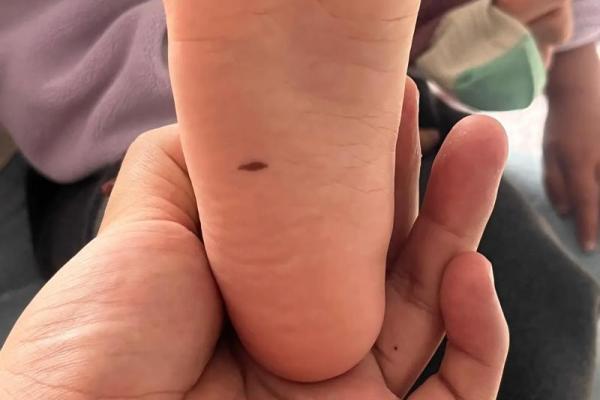 脚底痣的位置与含义完全解析