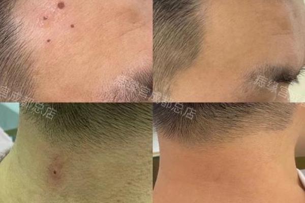 胸前痣的象征意义：不同位置痣的命运解读