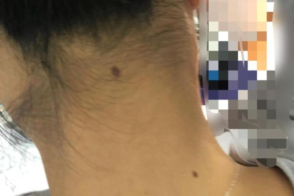 脖子上的秘密：相痣揭秘，个性标签大公开