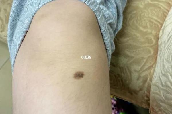 膝盖上的独特印记：女人膝盖痣的神奇功效