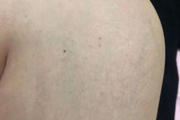小腿腹上的痣，到底藏着什么特殊含义？