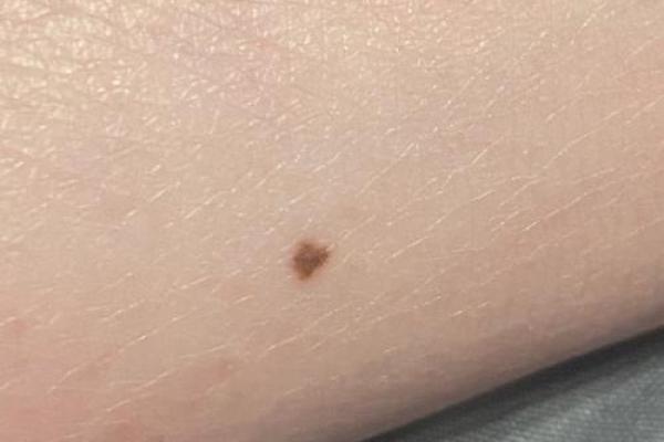 小腿腹上的痣，到底藏着什么特殊含义？
