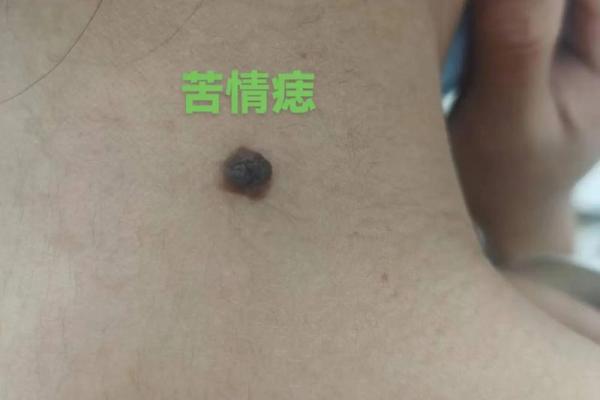 痣相大全揭秘：左右膝盖痣的神奇寓意