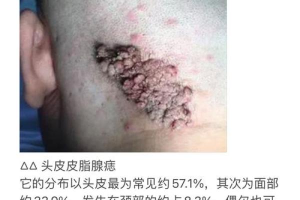 额头痣与头皮痣：解读身体上的神秘符号