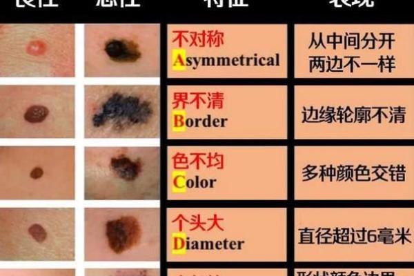 痣相揭秘：全面解析身体痣的秘密
