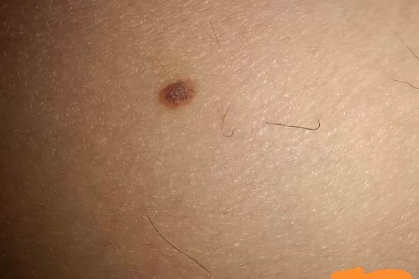 一痣定终身，大腿根部痣的秘密