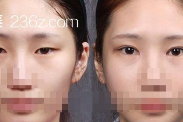 割双眼皮真的能改变面相？揭秘双眼皮整形背后的神奇魔力