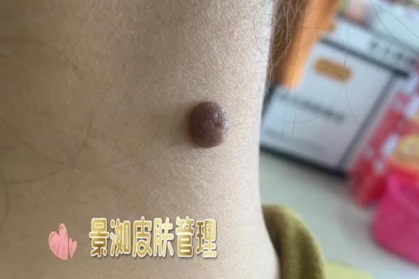 痣相揭秘：后脖痣男人的运势大解析