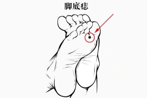 痣相解码：脚底痣，预示着什么样的未来？