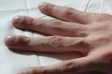 癌症手相揭秘：真相还是迷信？