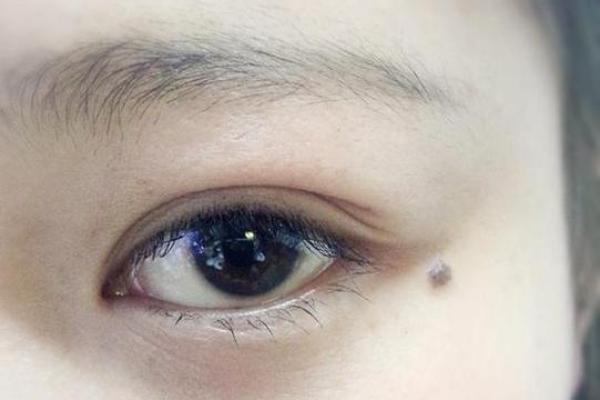 眼泪痣：命运中的泪滴，预示着怎样的命运？